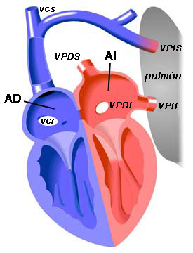 Drenaje Anmalo Parcial de Venas Pulmonares